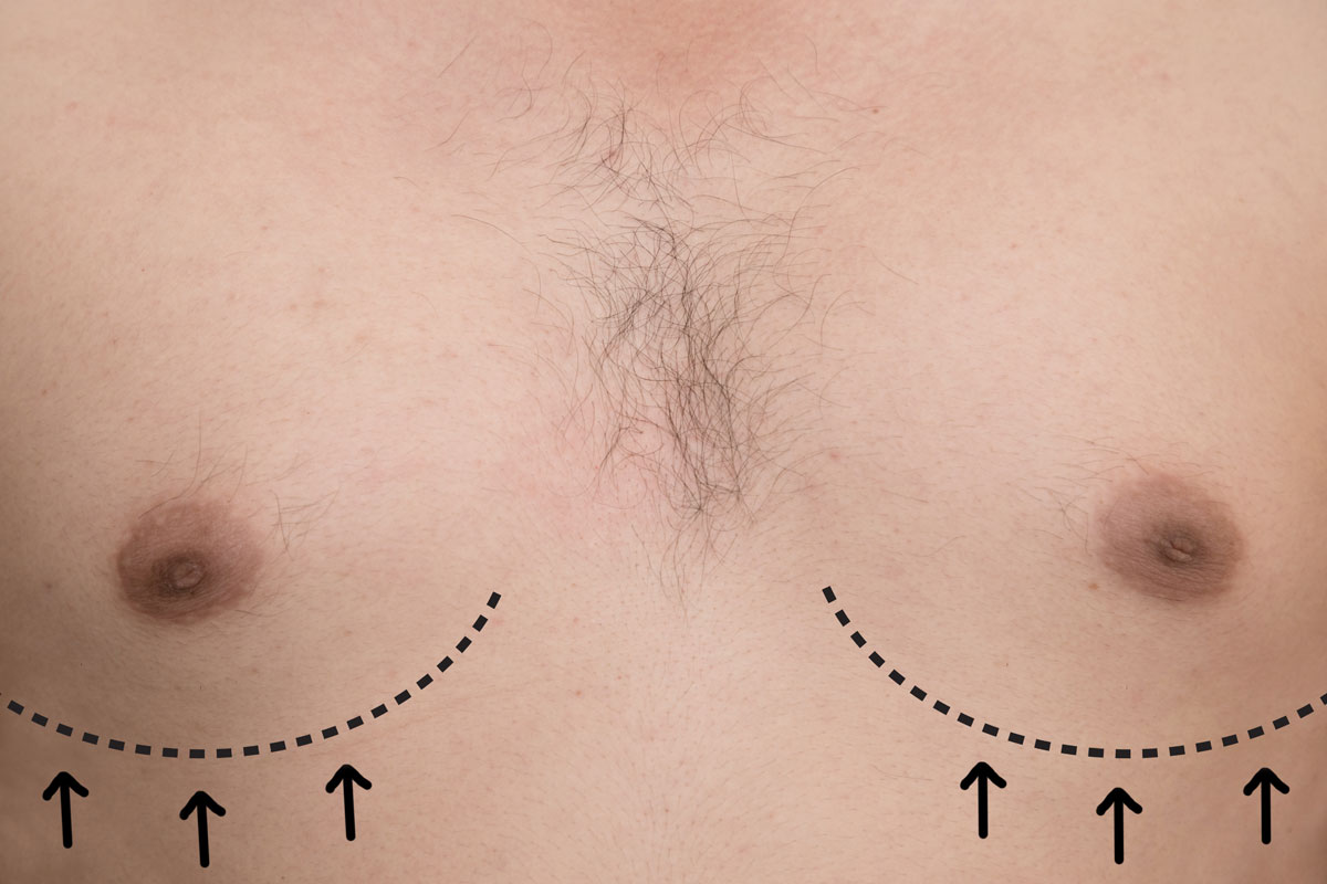 How to Target Gynecomastia Specialists for Medical Marketing Success